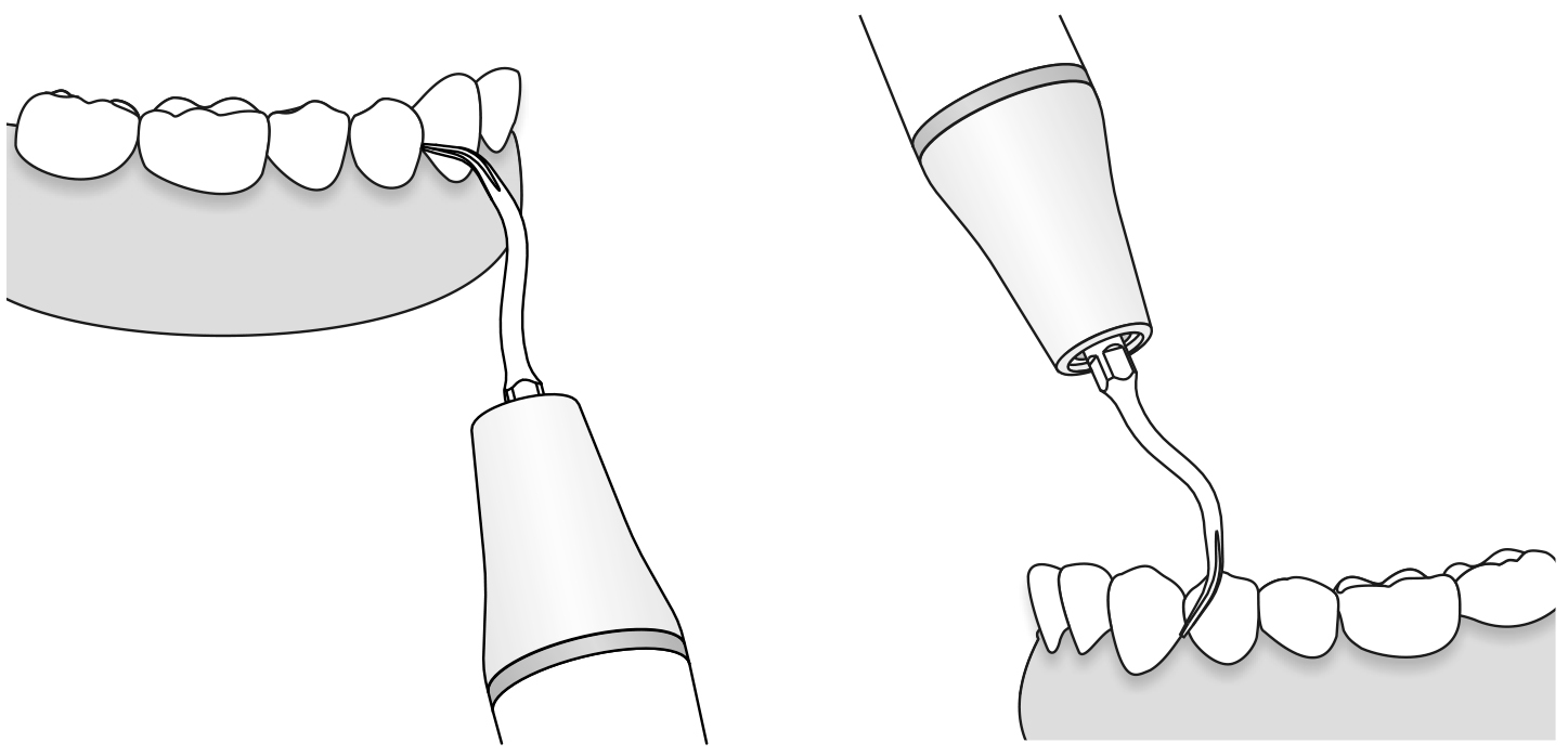 Сфера применения наконечника для скалера